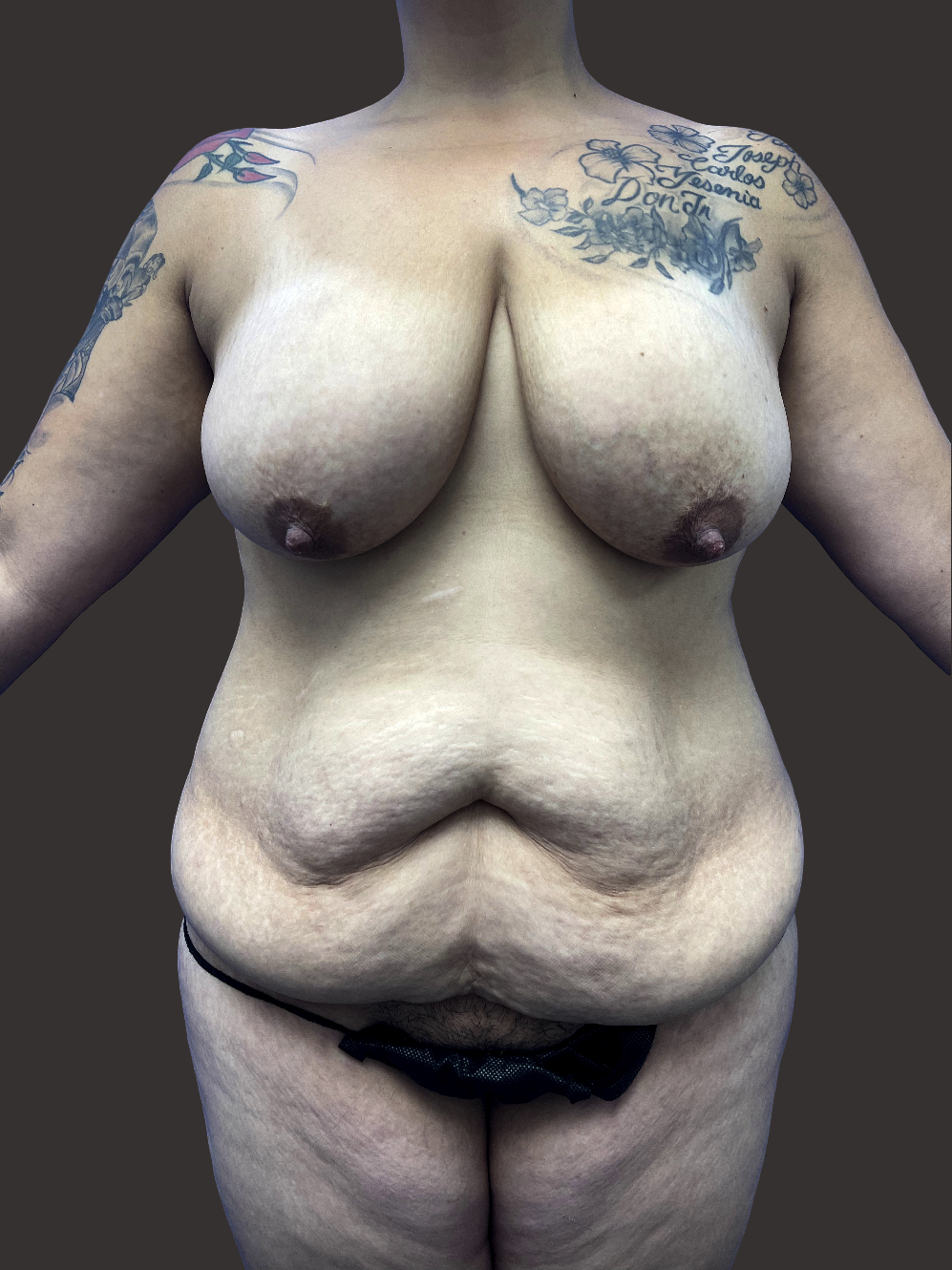 Case--9231-Mommy-Makeover | Before Body