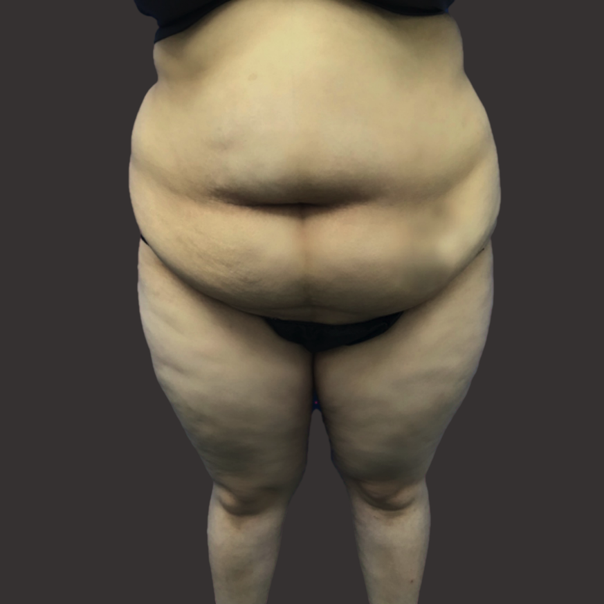 Case--1621-Post-Massive-Weight-Loss-Surgery | Before Body