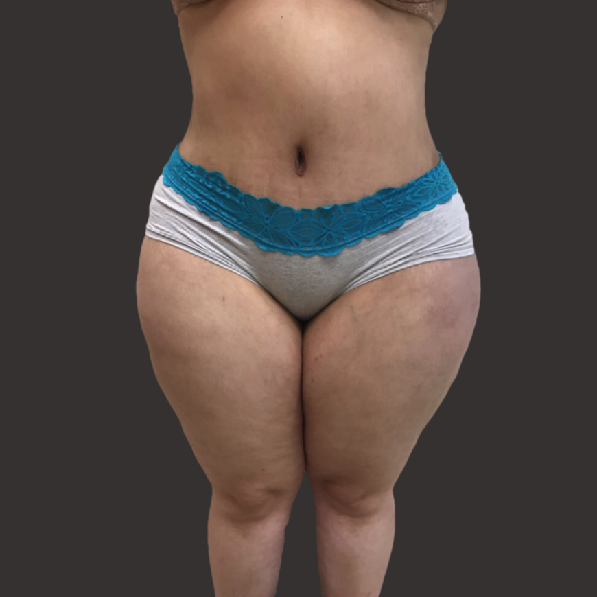 Case--1621-Post-Massive-Weight-Loss-Surgery | After Body