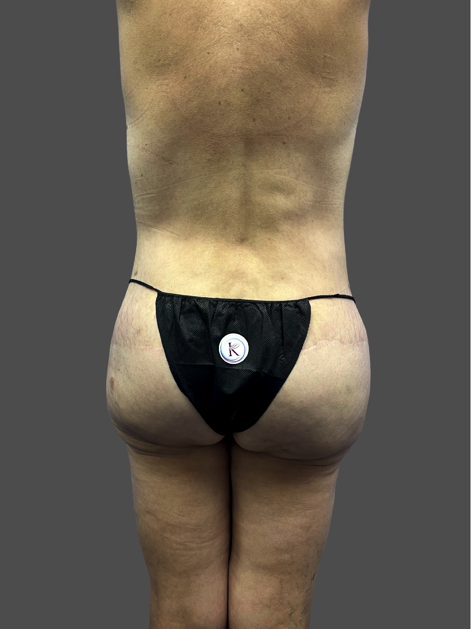 Case--3862-Liposuction | After Liposuction