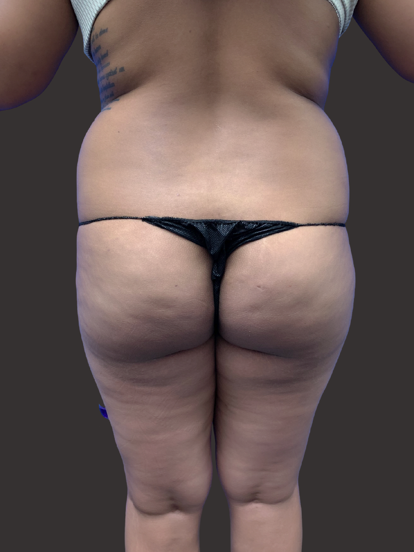 Case--7152-Liposuction | Before Body