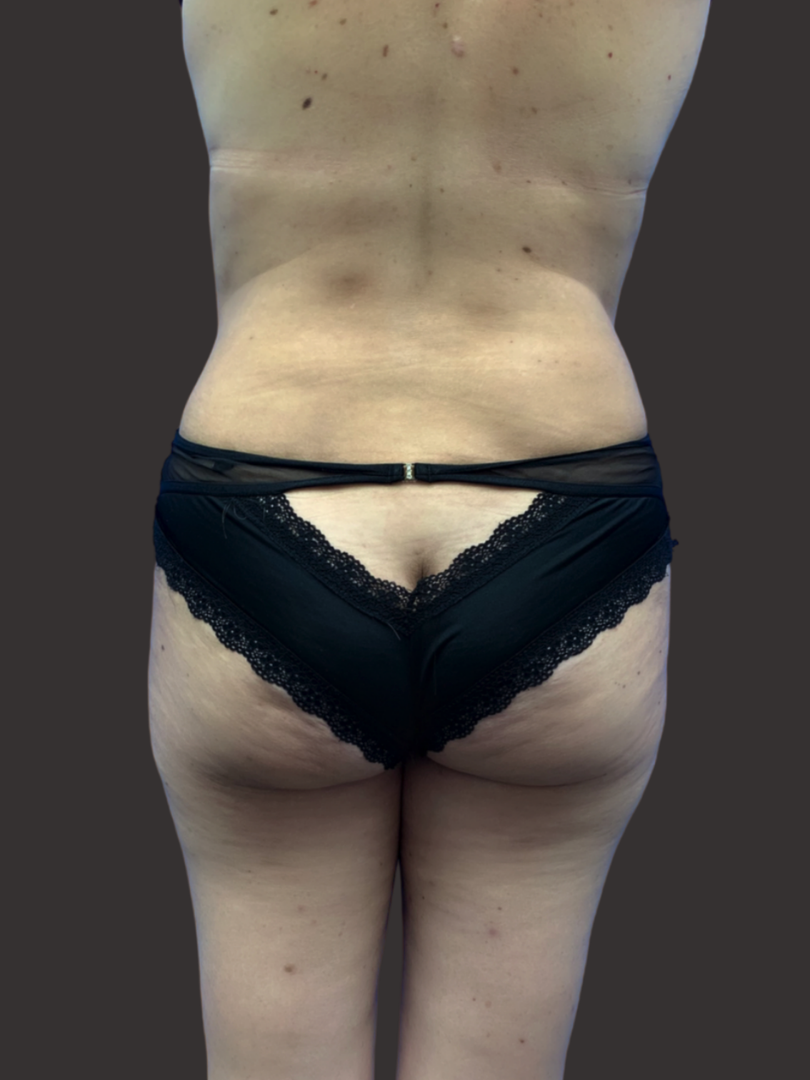 Case--4185-Liposuction | After Liposuction