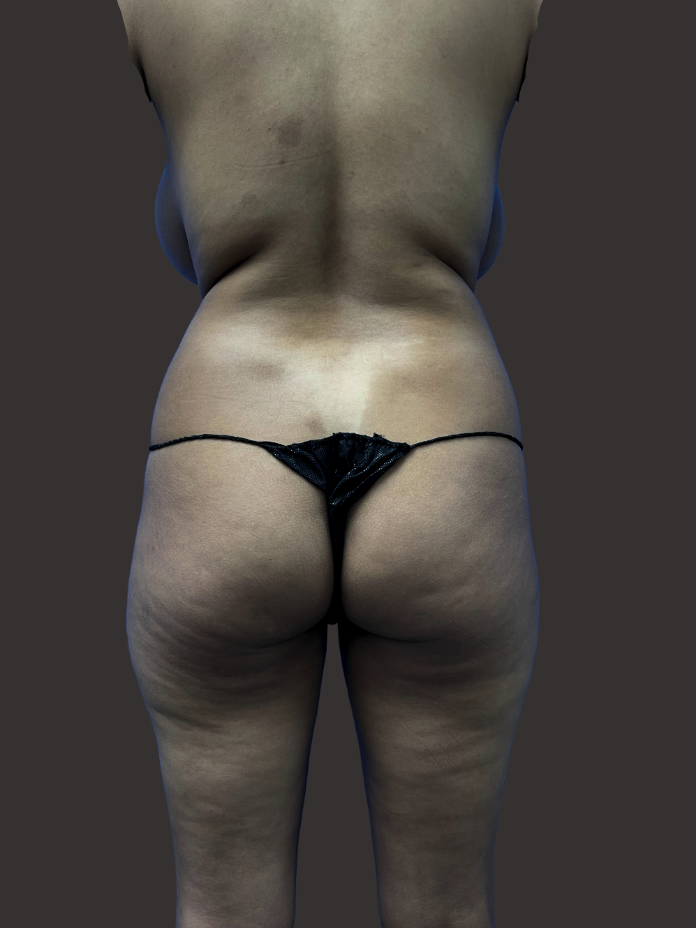 Case--7611-Brazilian-Butt-Lift | Before Body
