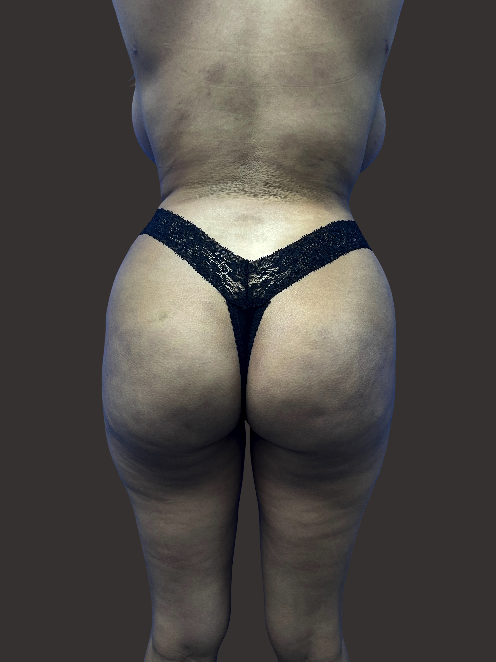 Case--5319-Liposuction | After Body