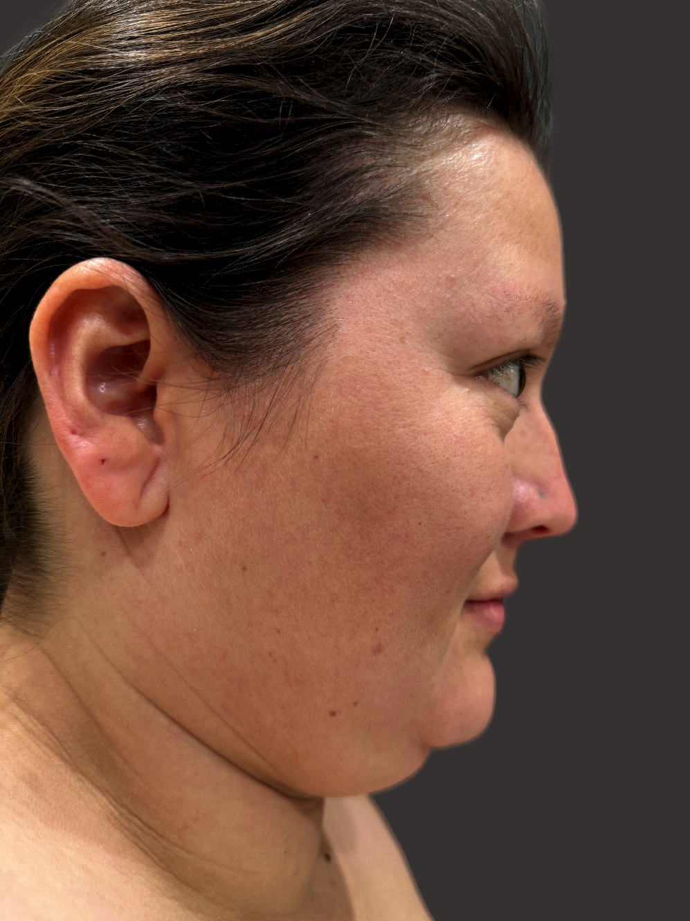 Case--7946-Neck-Liposuction | Before Neck Liposuction