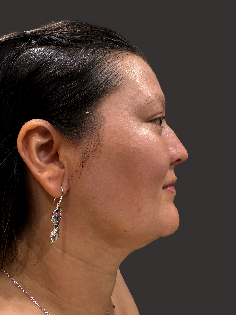 Case--7946-Neck-Liposuction | After Neck Liposuction