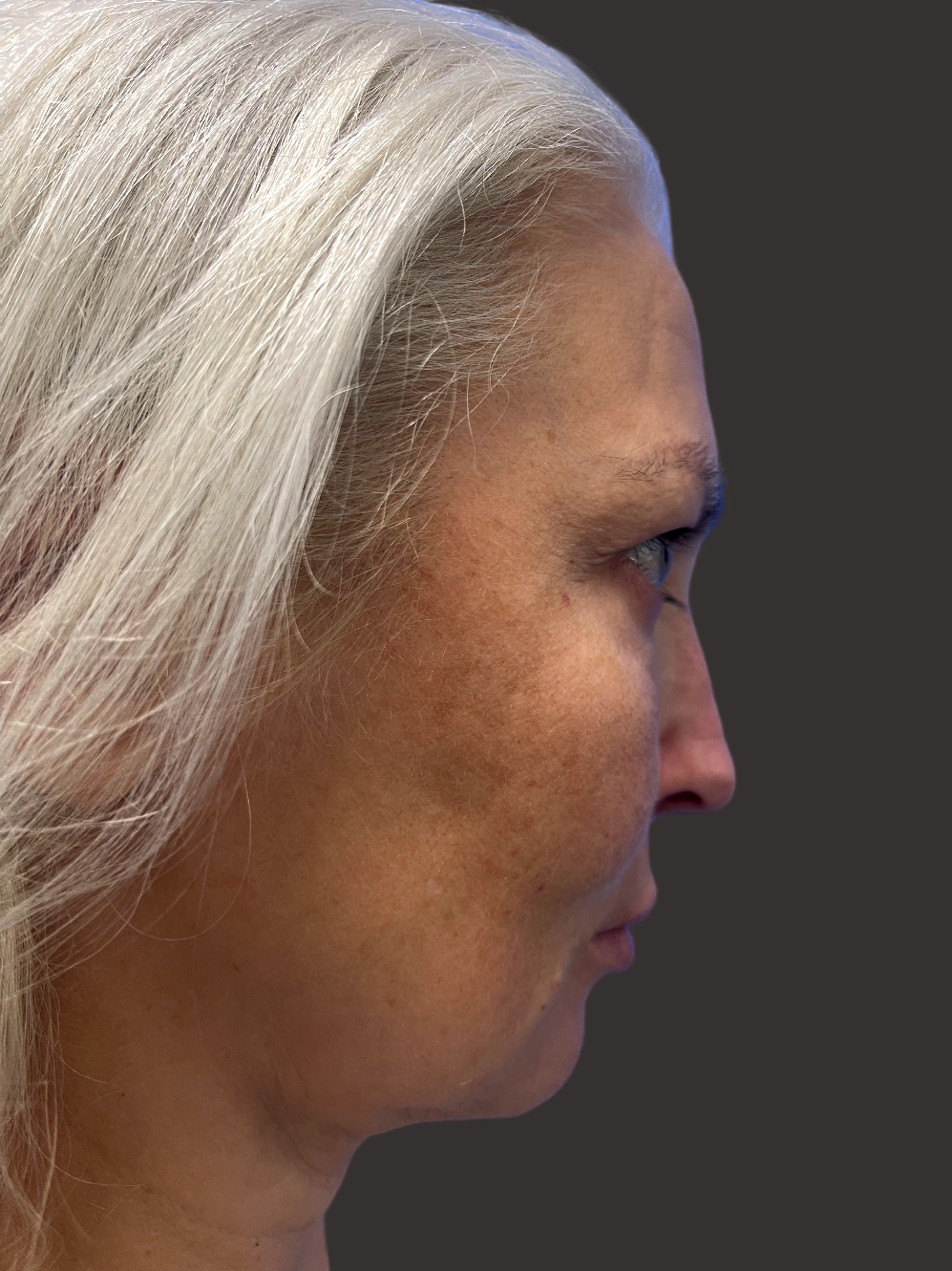 Before Facelift Gallery - Bruce Kadz Beverly Hills Plastic Surgery