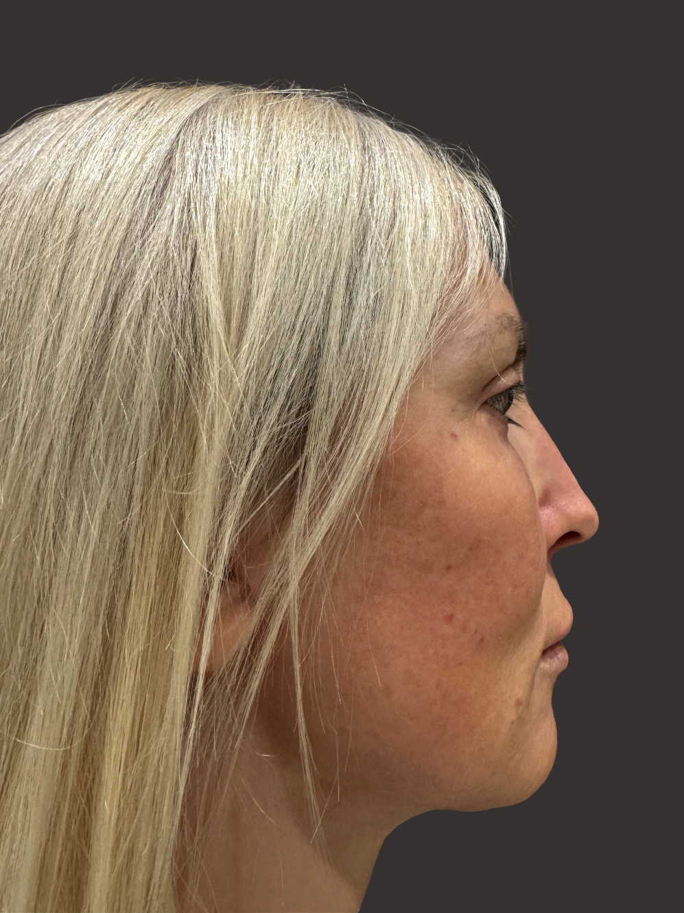 Before Facelift Gallery - Bruce Kadz Beverly Hills Plastic Surgery