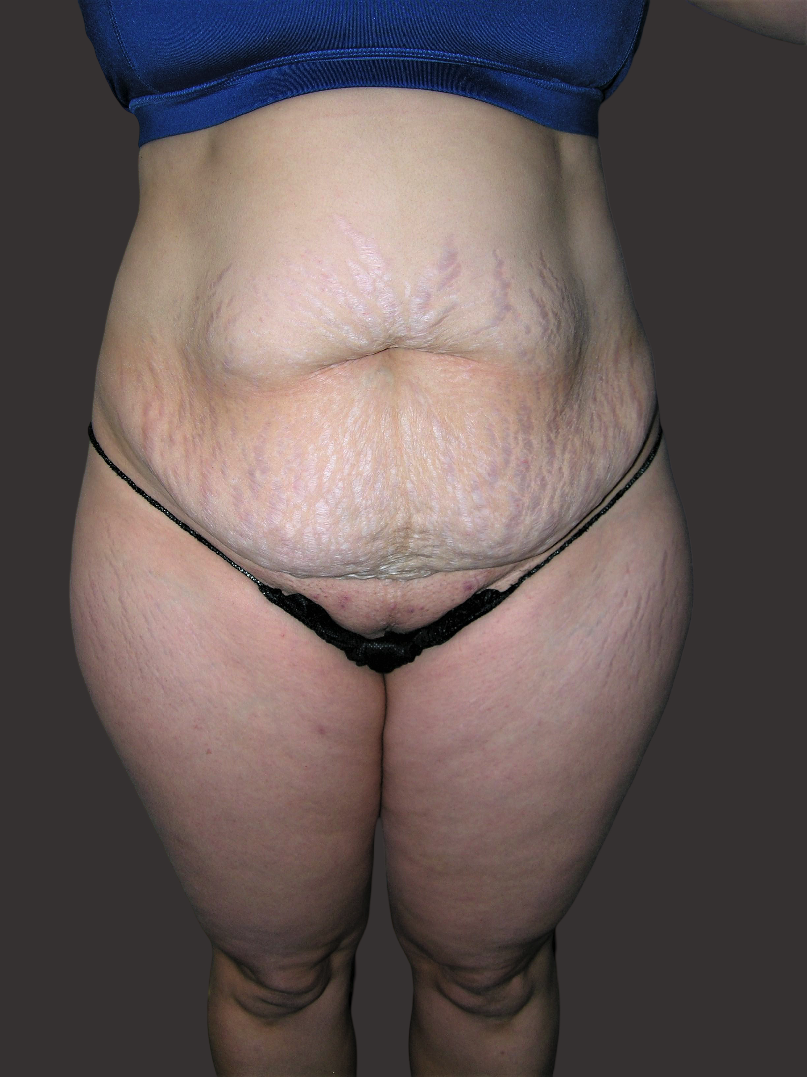 Case--6340-Tummy-Tuck | Before Tummy Tuck