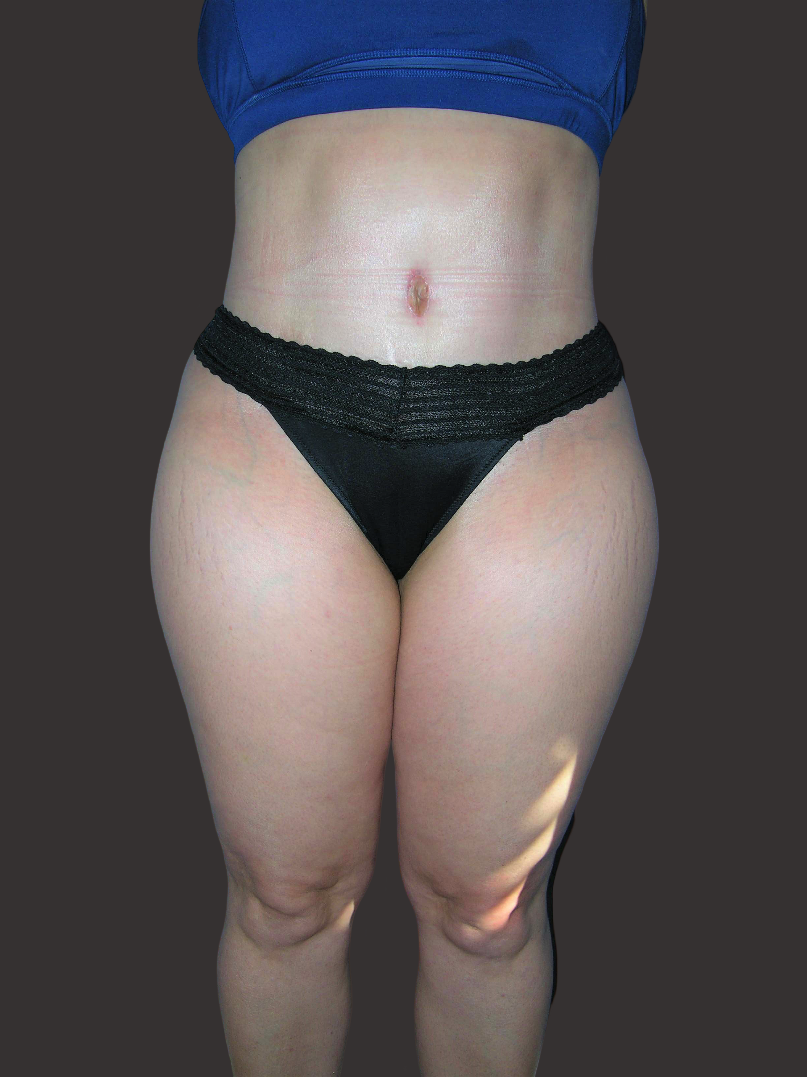 Case--6340-Tummy-Tuck | After Tummy Tuck
