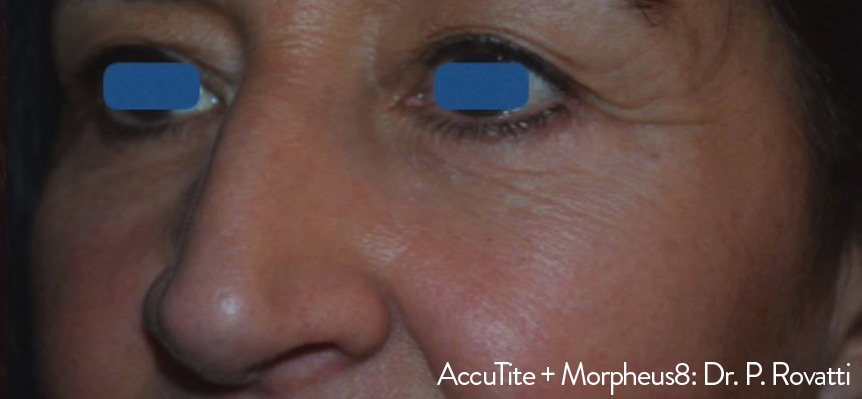 Case--9525-Morpheus8 | After Morpheus8