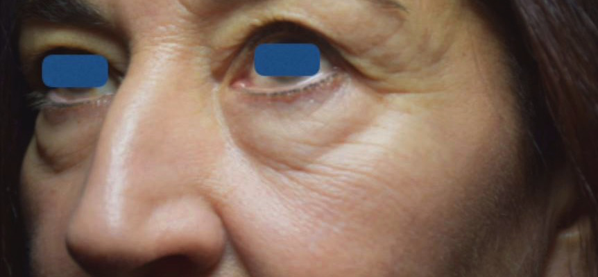 Case--9525-Morpheus8 | Before Morpheus8