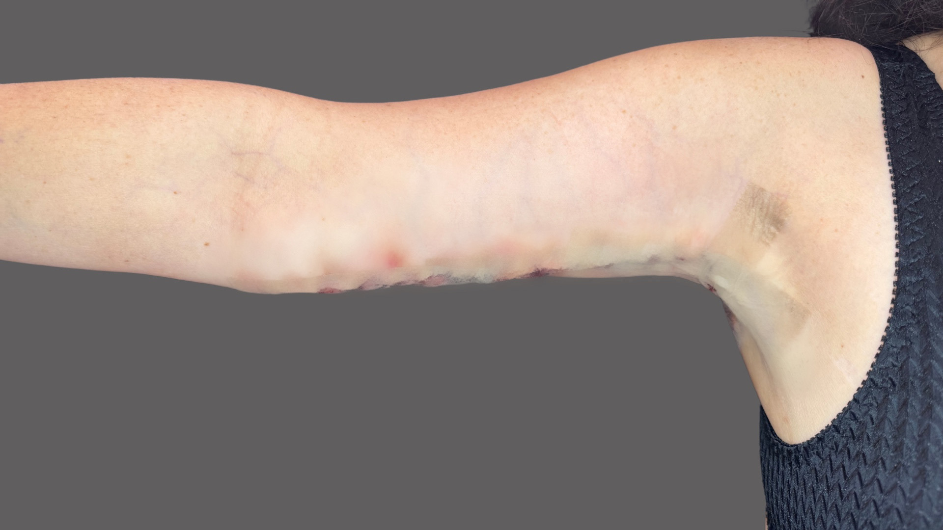 Case--1520 | After Body