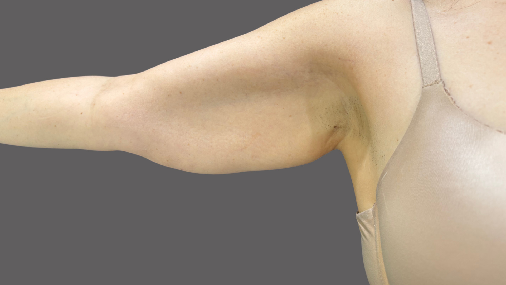 Case--1520 | Before Body