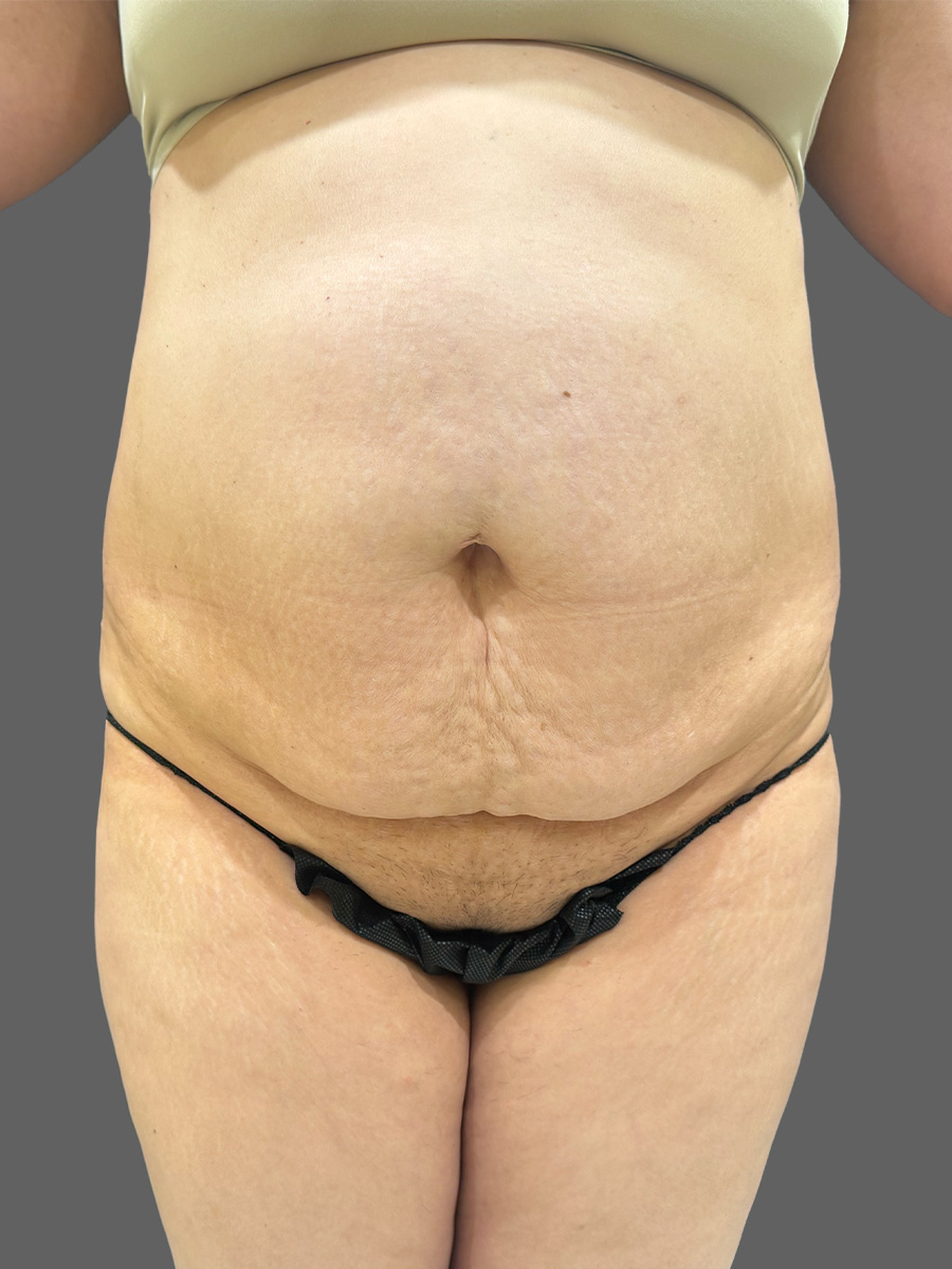 Case--1362 | Before Tummy Tuck