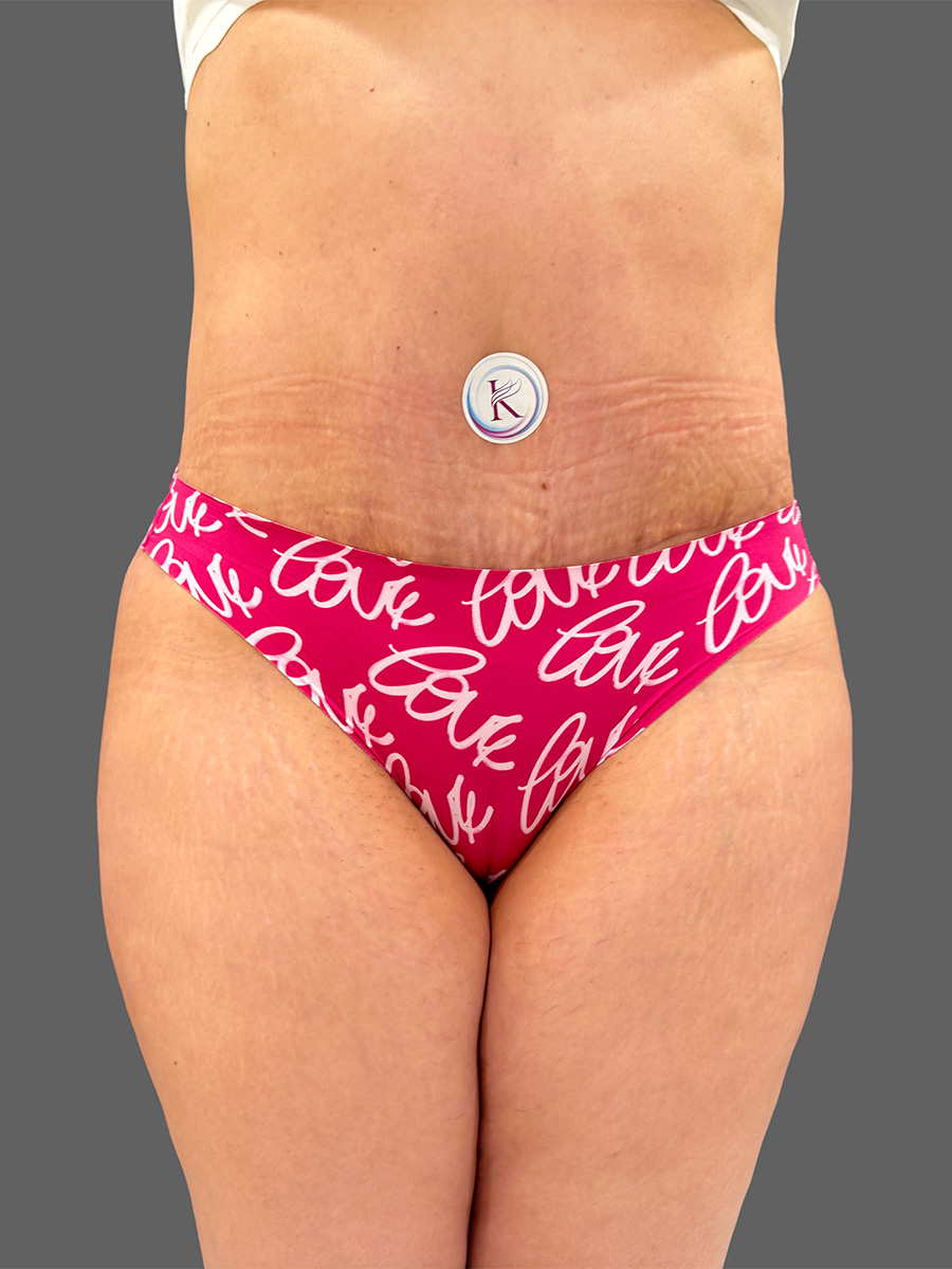 Case--1362 | After Tummy Tuck