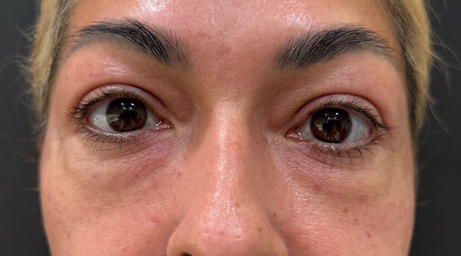 Case--2359 | Before Face