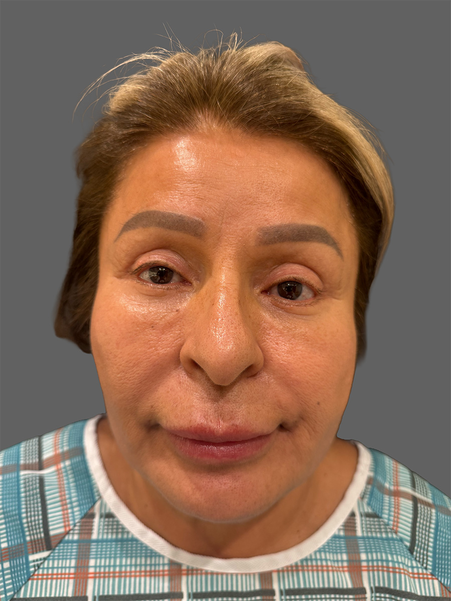 Case--4318 | Before Face