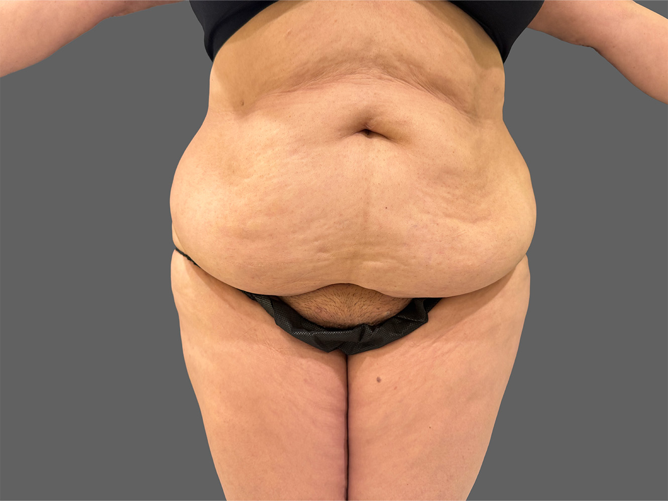 Case--5288 | Before Liposuction