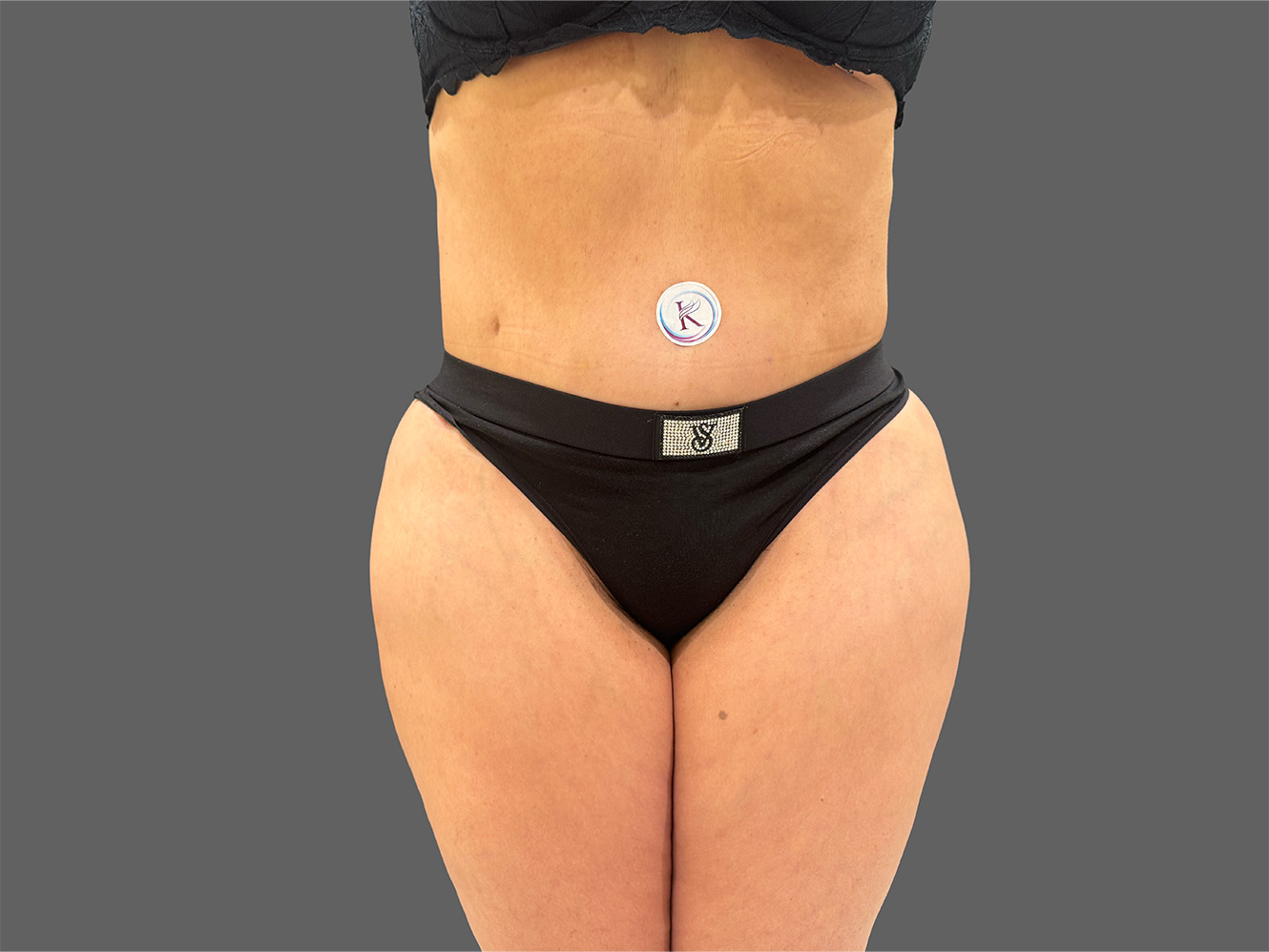 Case--5288 | After Liposuction