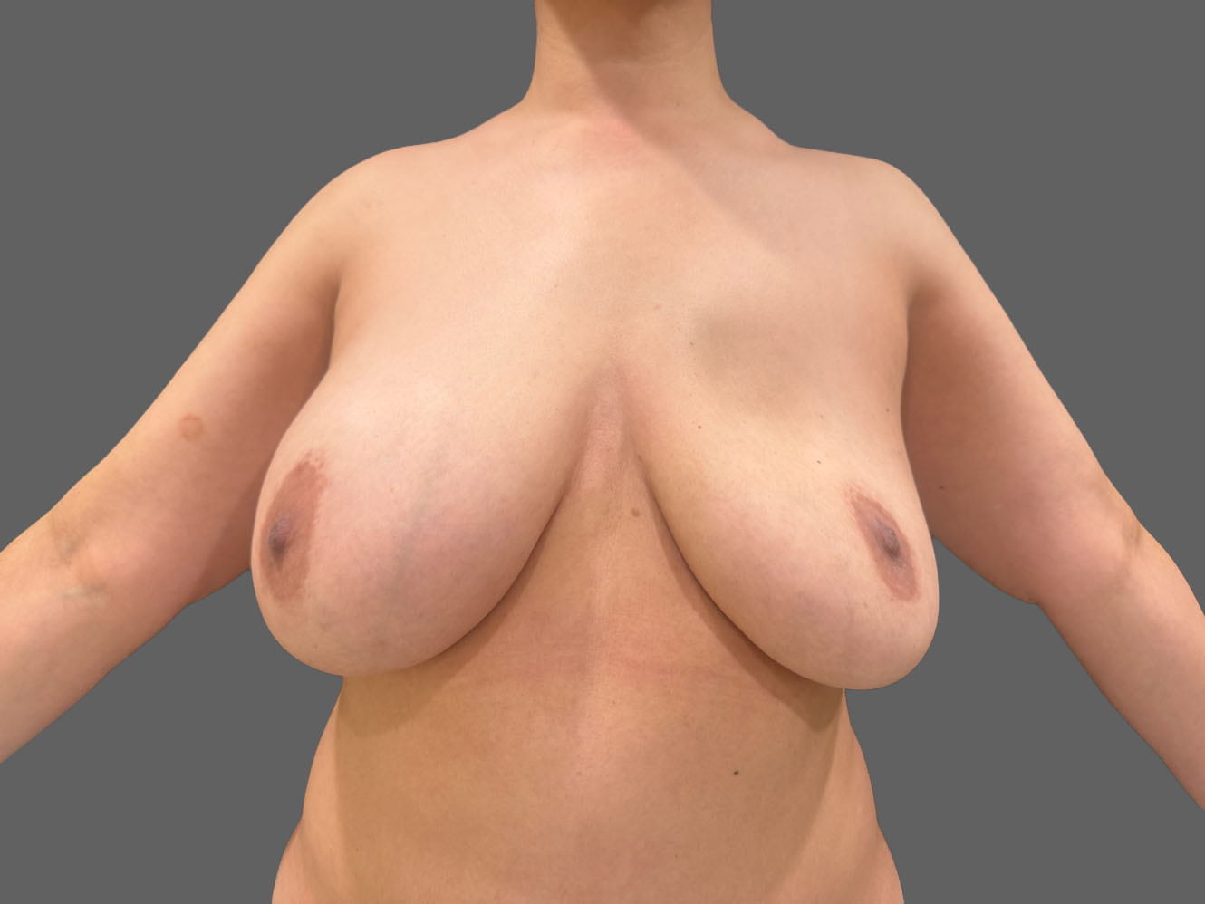 Case--5708 | Before Breast Augmentation