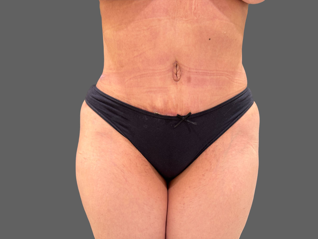 Case--5708a | After Liposuction