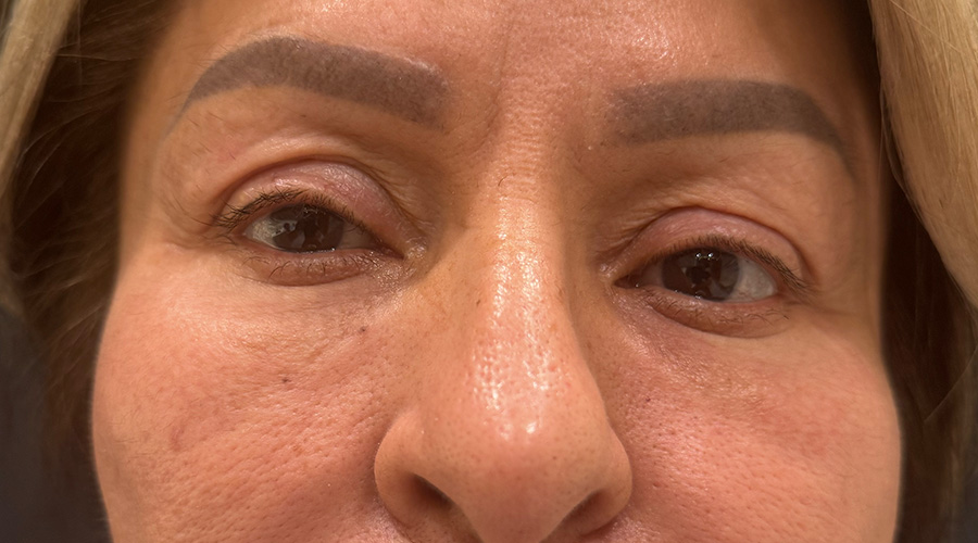 Case--6468 | Before Face