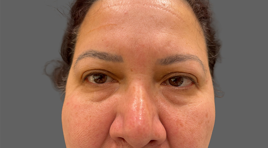 Case--7311a | Before Face