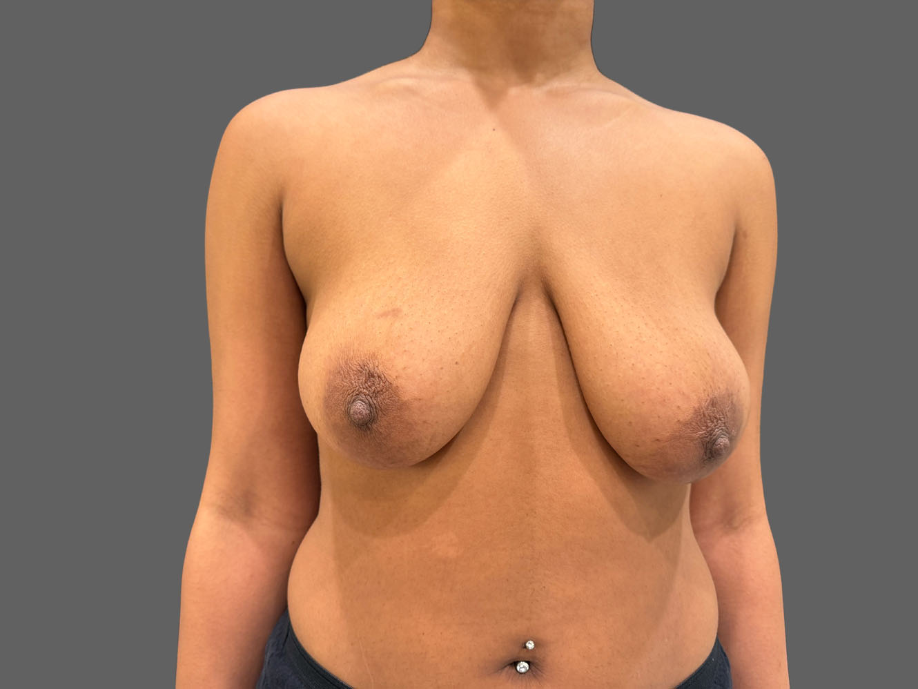 Case--9471 | Before Breast Lift