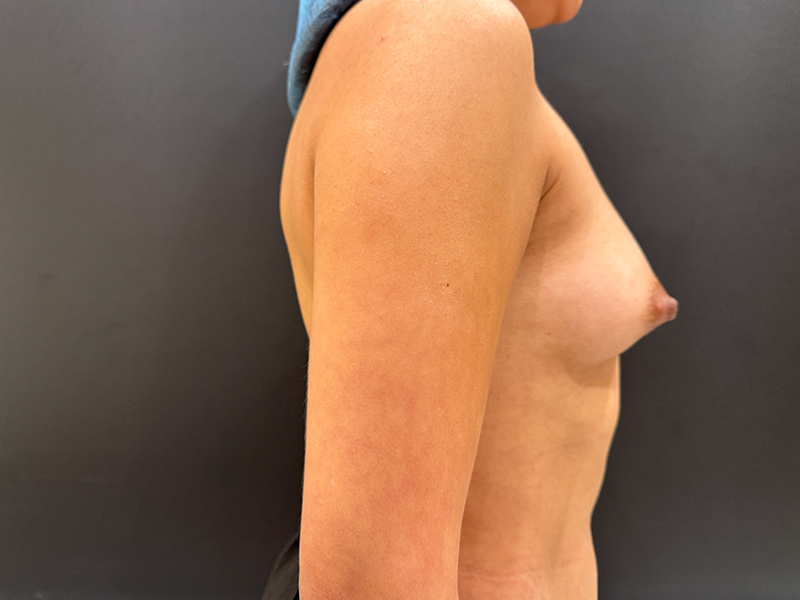Case--3472 | Before Breast Augmentation with Lift