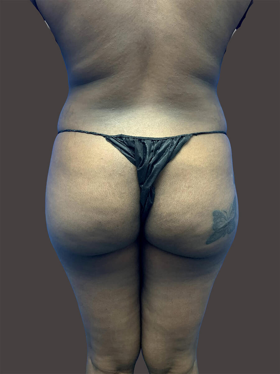 Case--3913-Brazilian-Butt-Lift | Before Body