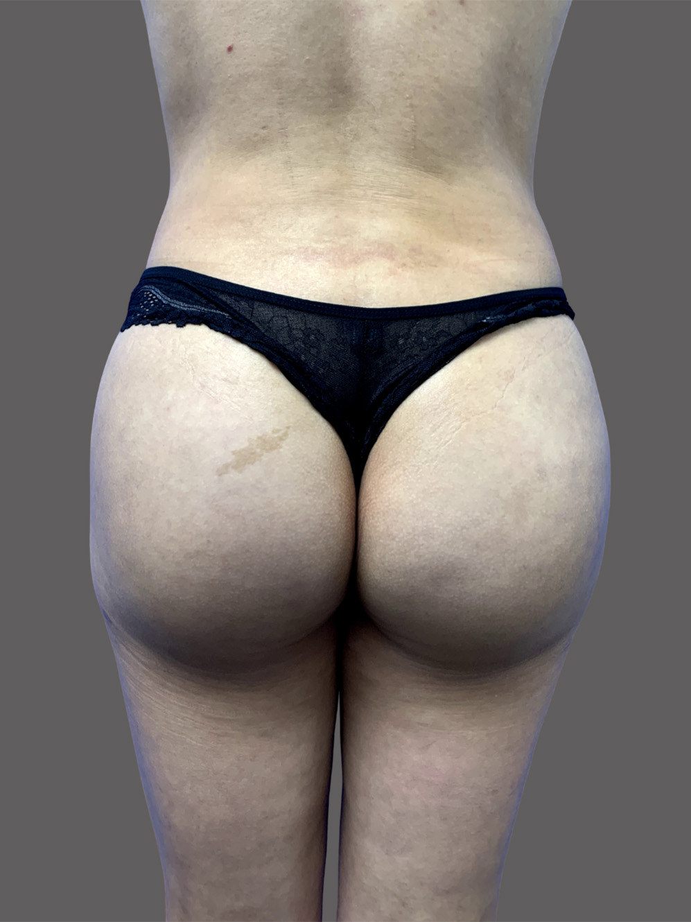 Case--5328-Brazilian-Butt-Lift | After Brazilian Butt Lift