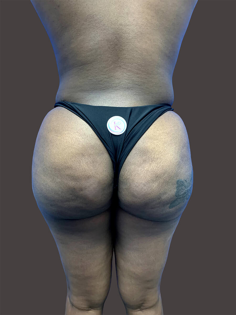 Case--3913-Brazilian-Butt-Lift | After Body