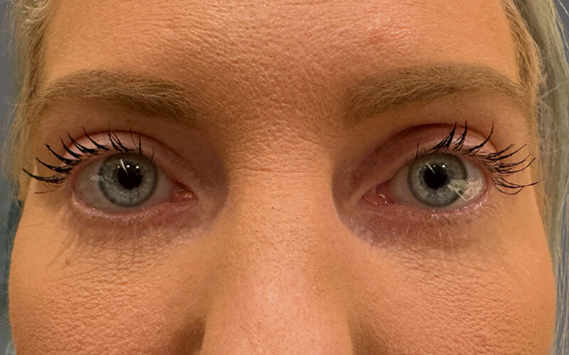 Case--1676-Eyelid-Lift | After Eyelid Lift