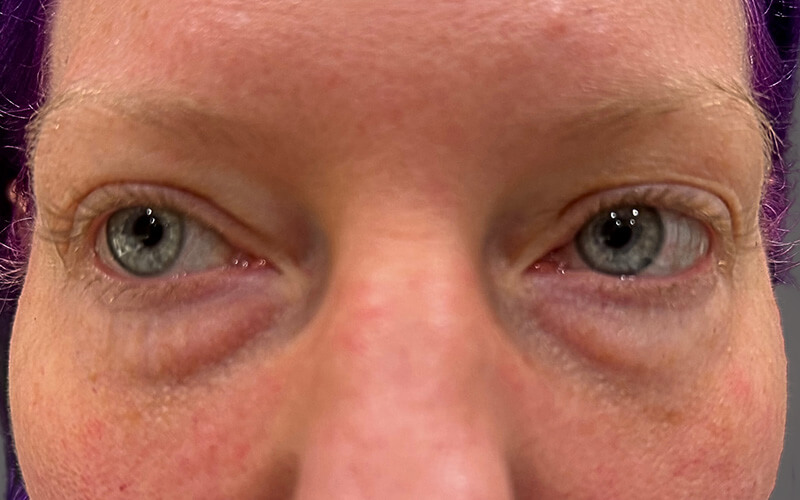 Case--1676-Eyelid-Lift | Before Eyelid Lift