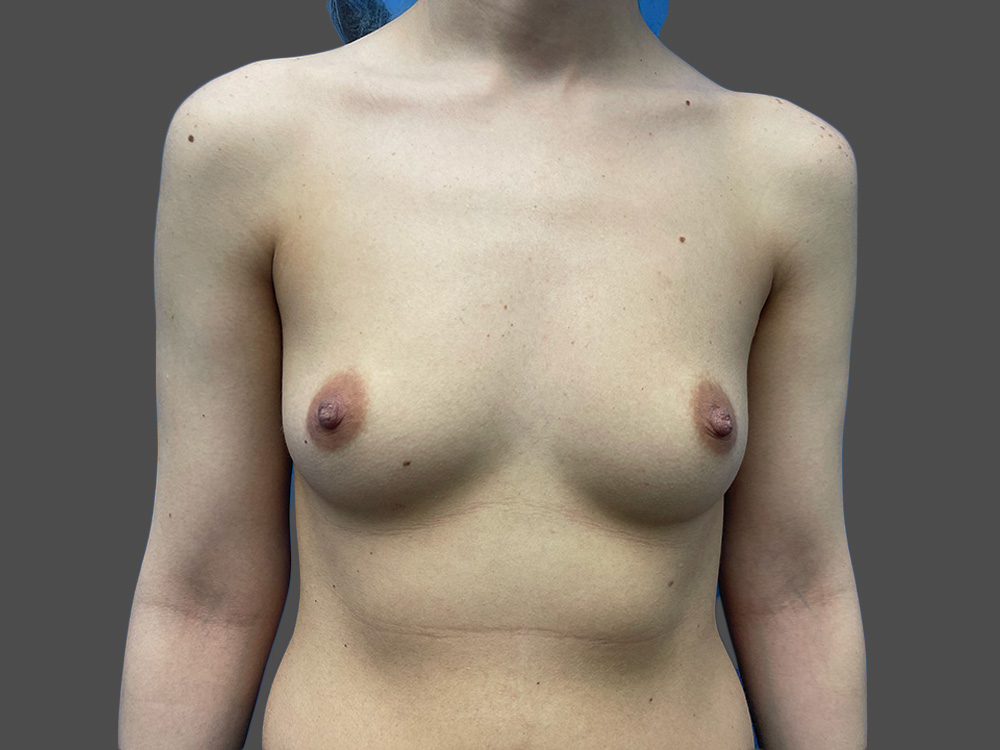 Case--3229-Breast-Augmentation | Before Breast Augmentation