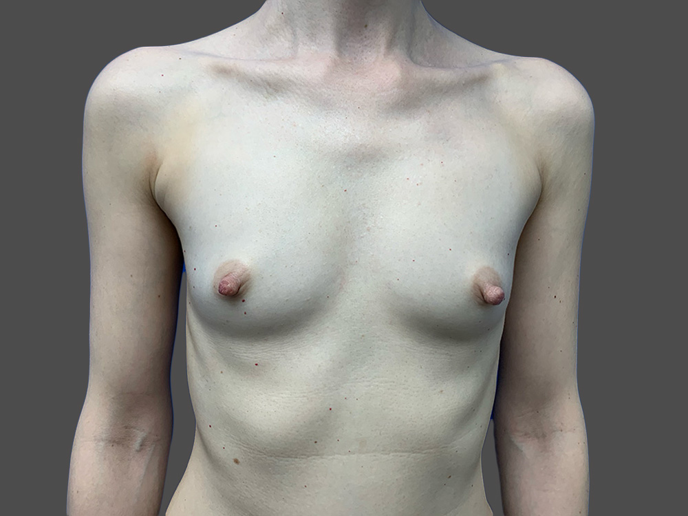 Case--7037-Breast-Augmentation | Before Breast Augmentation
