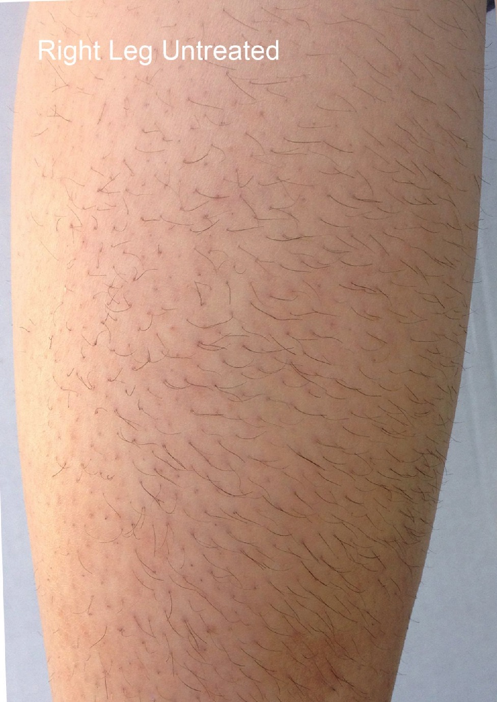 Case--7517-DiolazeXL | Before DiolazeXL