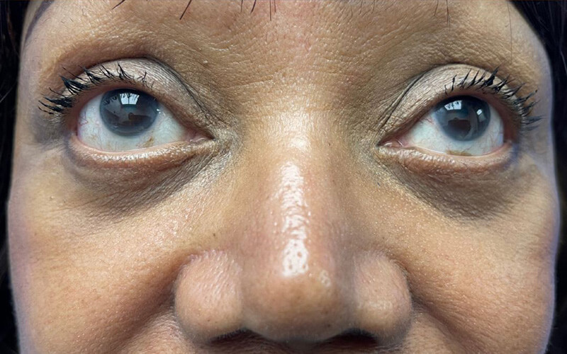 Case--1894-Eyelid-Lift | After Eyelid Lift