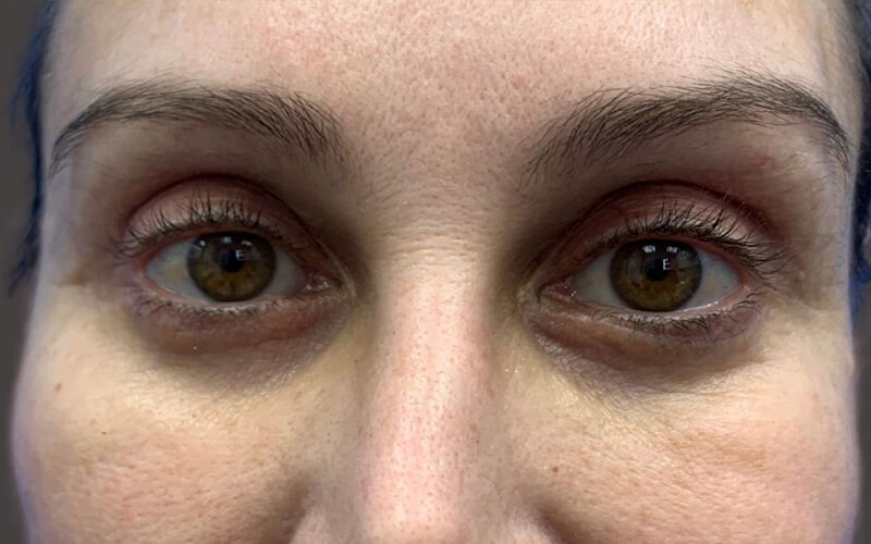 Case--4591-Eyelid-Lift | After Eyelid Lift