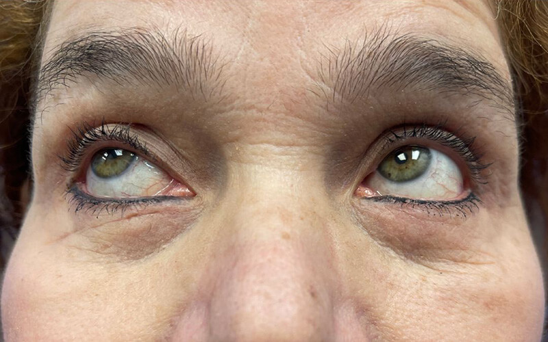 Case--8716-Eyelid-Lift | After Eyelid Lift