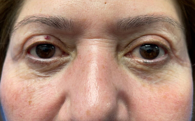 Case--3616-Eyelid-Lift | After Eyelid Lift