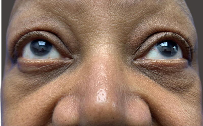 Case--1894-Eyelid-Lift | Before Eyelid Lift