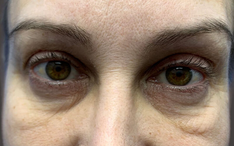 Case--4591-Eyelid-Lift | Before Eyelid Lift