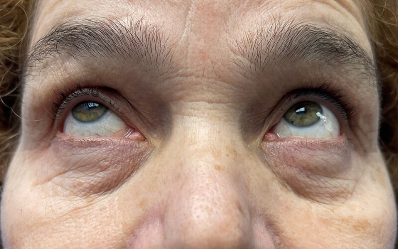 Case--8716-Eyelid-Lift | Before Eyelid Lift