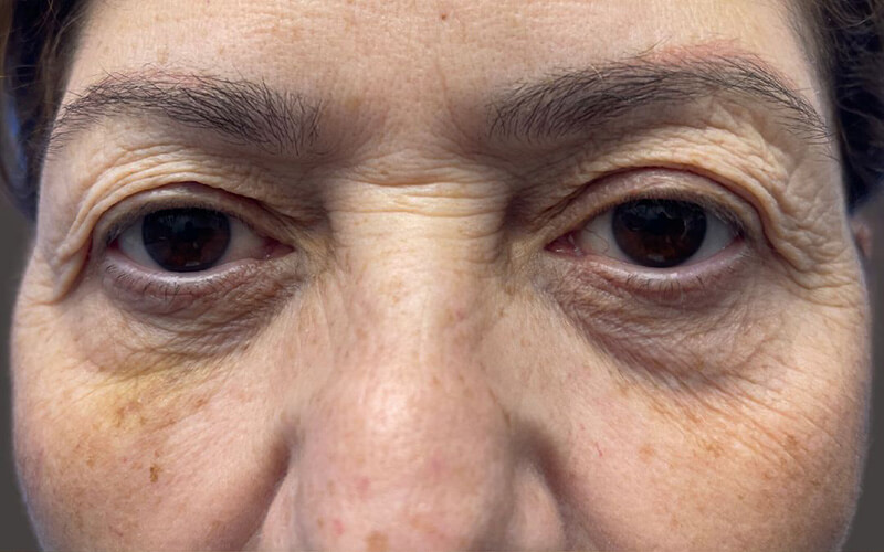 Case--3616-Eyelid-Lift | Before Eyelid Lift