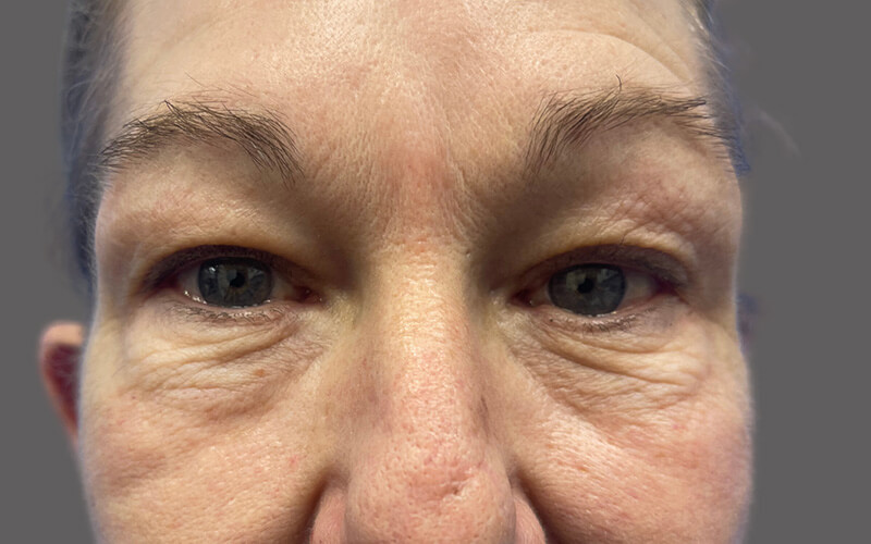 Case--1179-Eyelid-Lift | Before Eyelid Lift