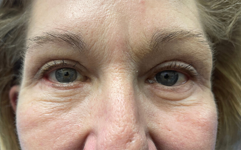 Case--1179-Eyelid-Lift | After Eyelid Lift
