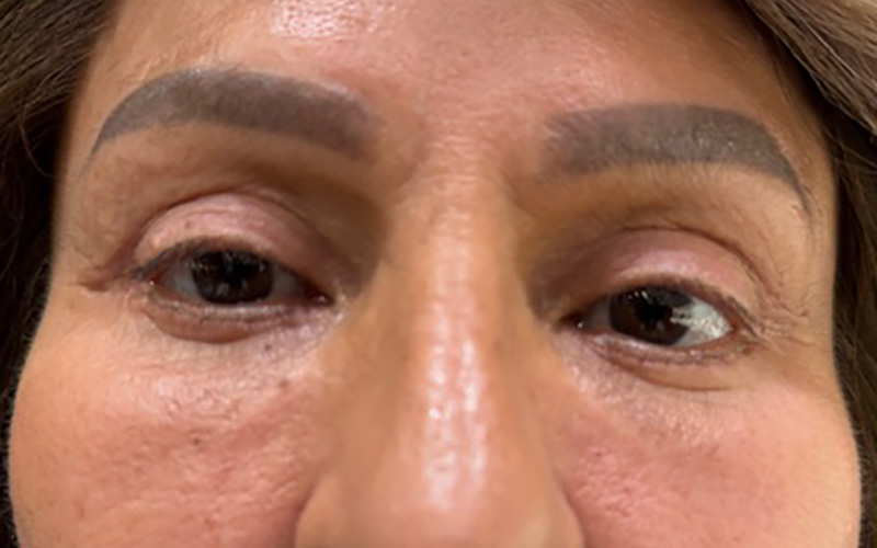 Case--5164-Eyelid-Lift | After Eyelid Lift