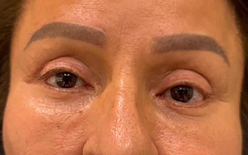Case--5164-Eyelid-Lift | Before Eyelid Lift